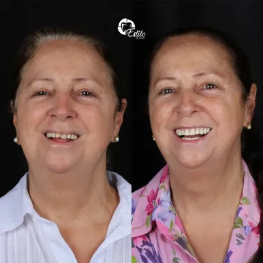 Caso clínico de reabilitação com prótese protocolo publicado pela Clínica Estilo